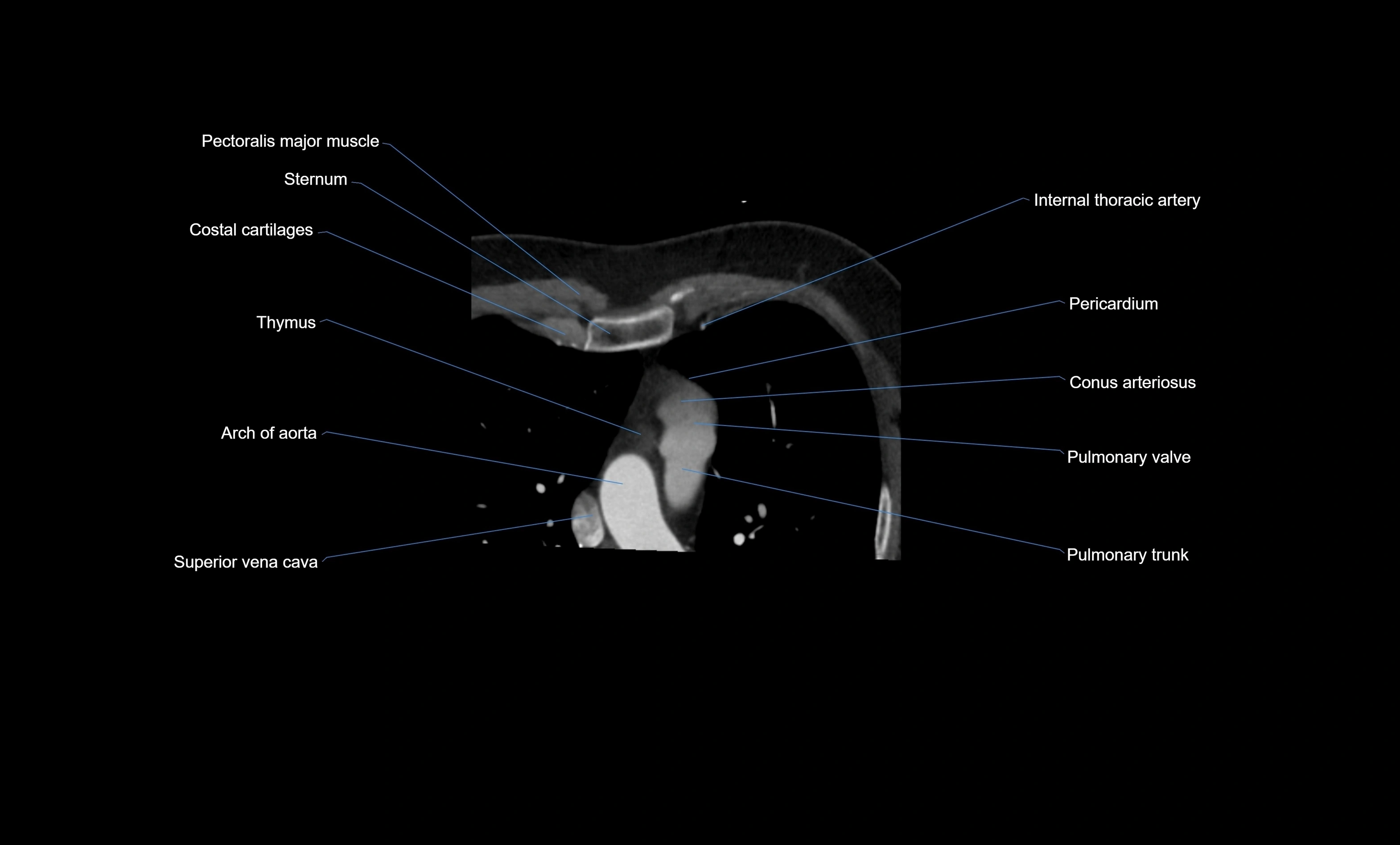 CT heart (coronary angiogram) four chamber view  cross sectional anatomy labelled radiology image -00010.webp